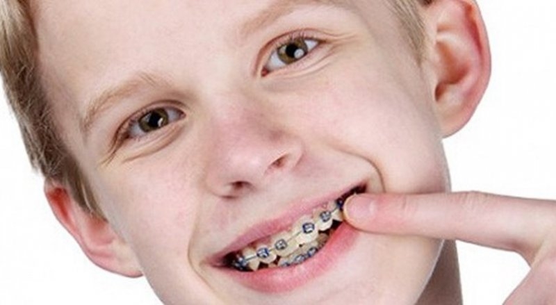 Gaziantep Çocuk Ortodontist Çocuklarda Ortodonti